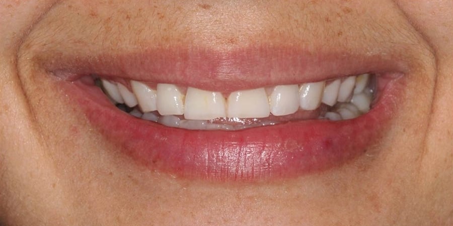 зубы до протирования на имплантах