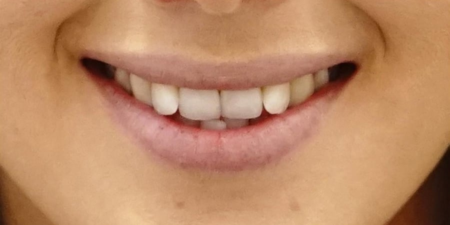 до установки коронок в стоматологической клинике