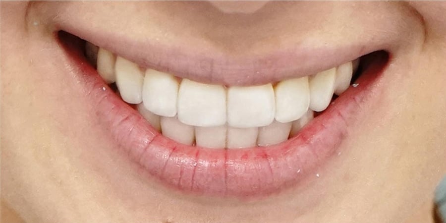 после установки коронок в стоматологической клинике