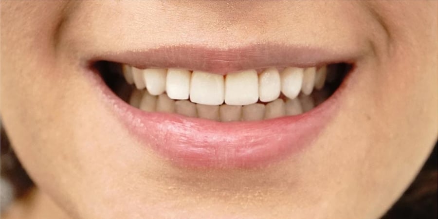 изготовление виниров калининград