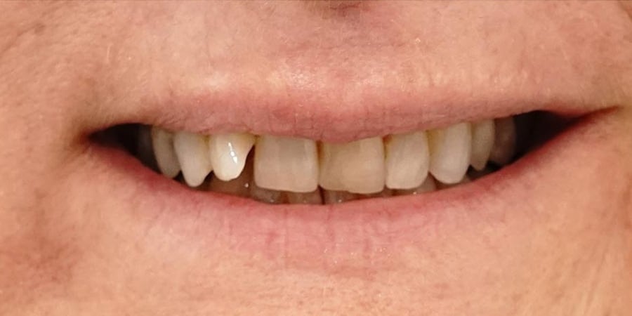 Имплантация зубов по акции