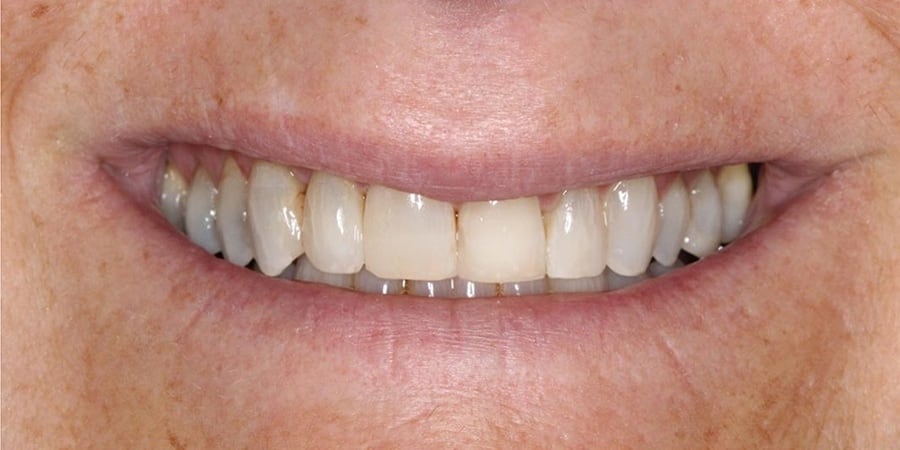 Результат имплантации зубов