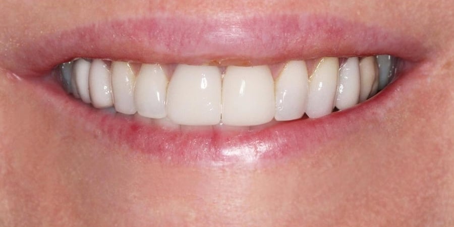 Зубы после протезирования