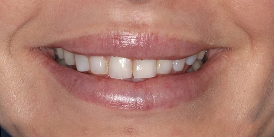 до проведения протезирования зубов