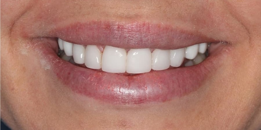 после проведения протезирования зубов