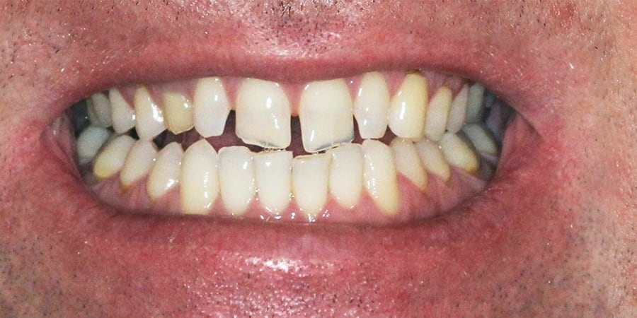 до установки имплантов