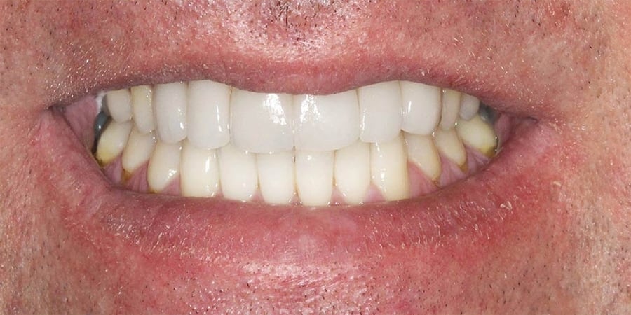 после установки имплантов