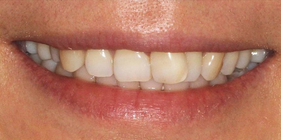 до установки виниров