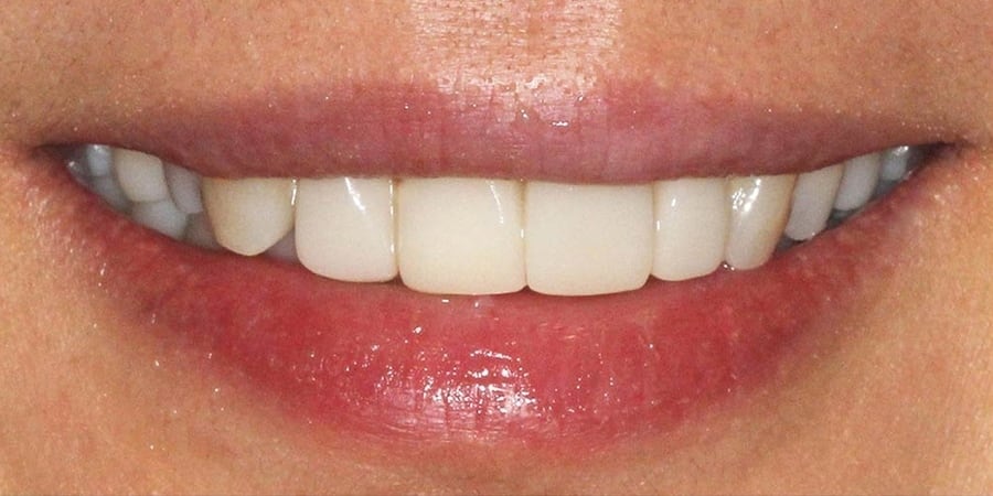 после установки виниров