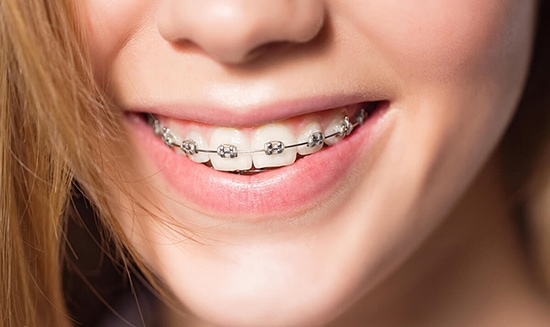 Если зубы неровные